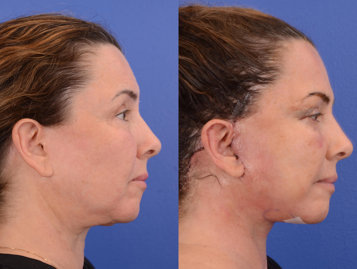 Recovery Before & After Gallery - Patient 256704 - Image 3