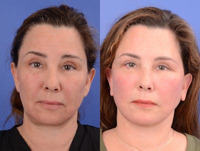 Recovery Before & After Gallery - Patient 239347 - Image 1