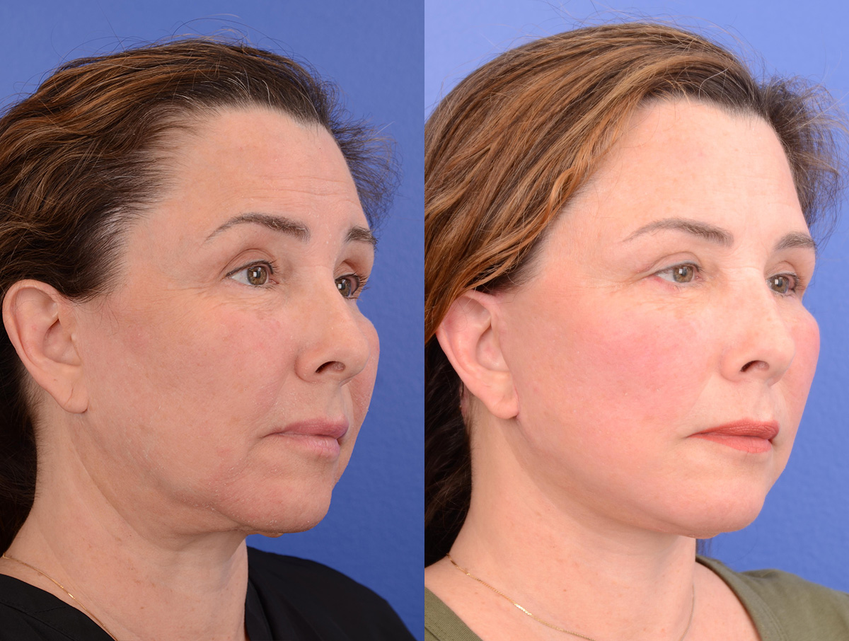 Facelift Before & After Gallery - Patient 658356 - Image 2