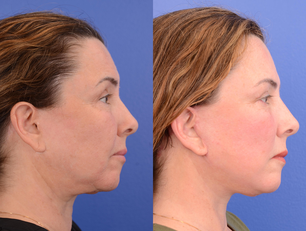 Facelift Before & After Gallery - Patient 658356 - Image 3