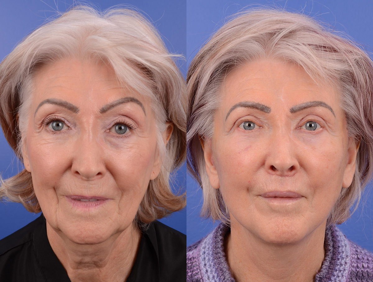 Recovery Before & After Gallery - Patient 213728 - Image 2