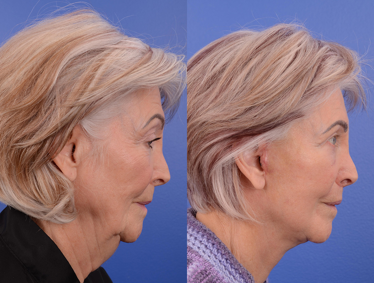 Recovery Before & After Gallery - Patient 213728 - Image 3