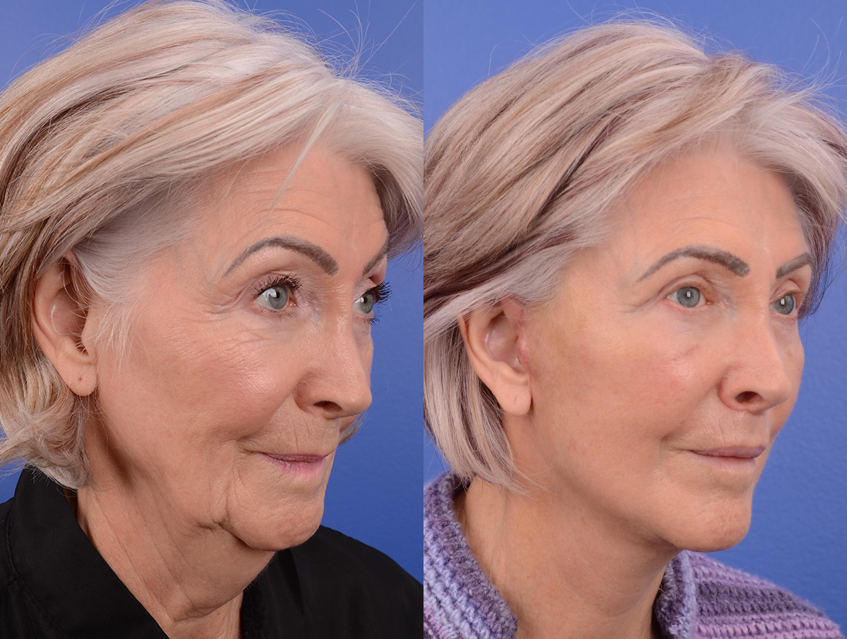 Recovery Before & After Gallery - Patient 213728 - Image 1