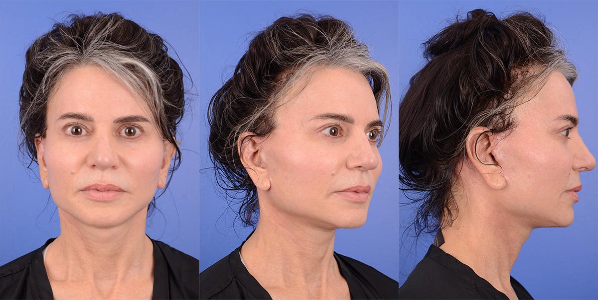 Recovery Before & After Gallery - Patient 174891 - Image 1