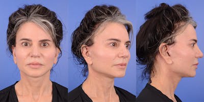 Recovery Before & After Gallery - Patient 174891 - Image 1