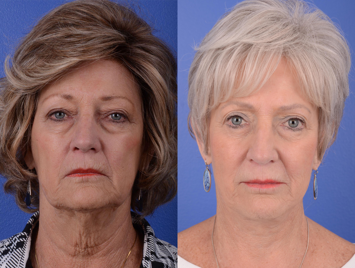 Long Term Results Before & After Gallery - Patient 319915 - Image 1
