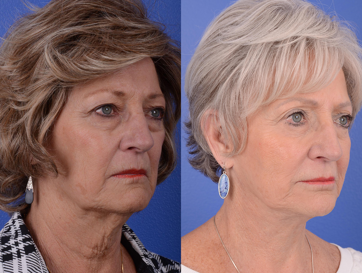 Long Term Results Before & After Gallery - Patient 319915 - Image 2