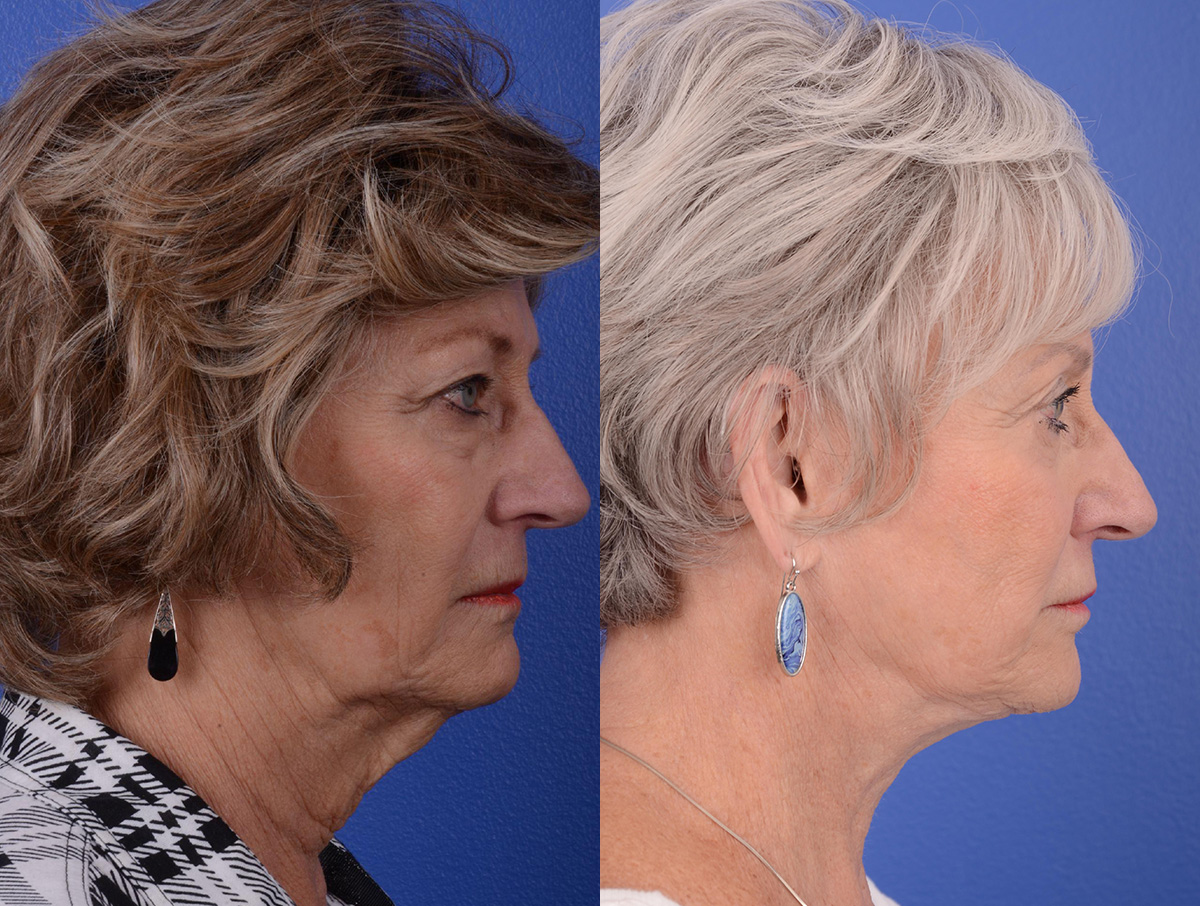 Long Term Results Before & After Gallery - Patient 319915 - Image 3