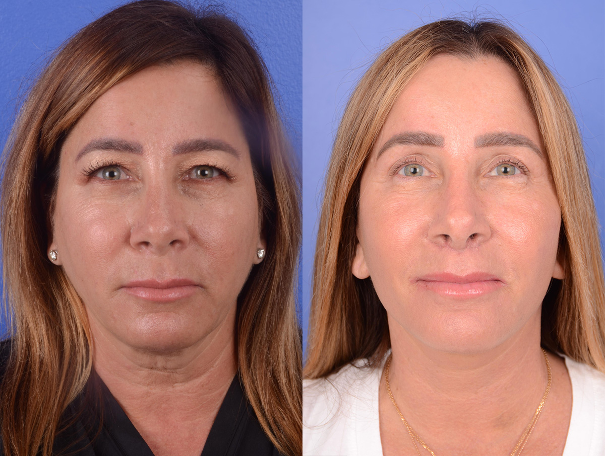 Facial Fat Grafting Before & After Gallery - Patient 351467 - Image 1