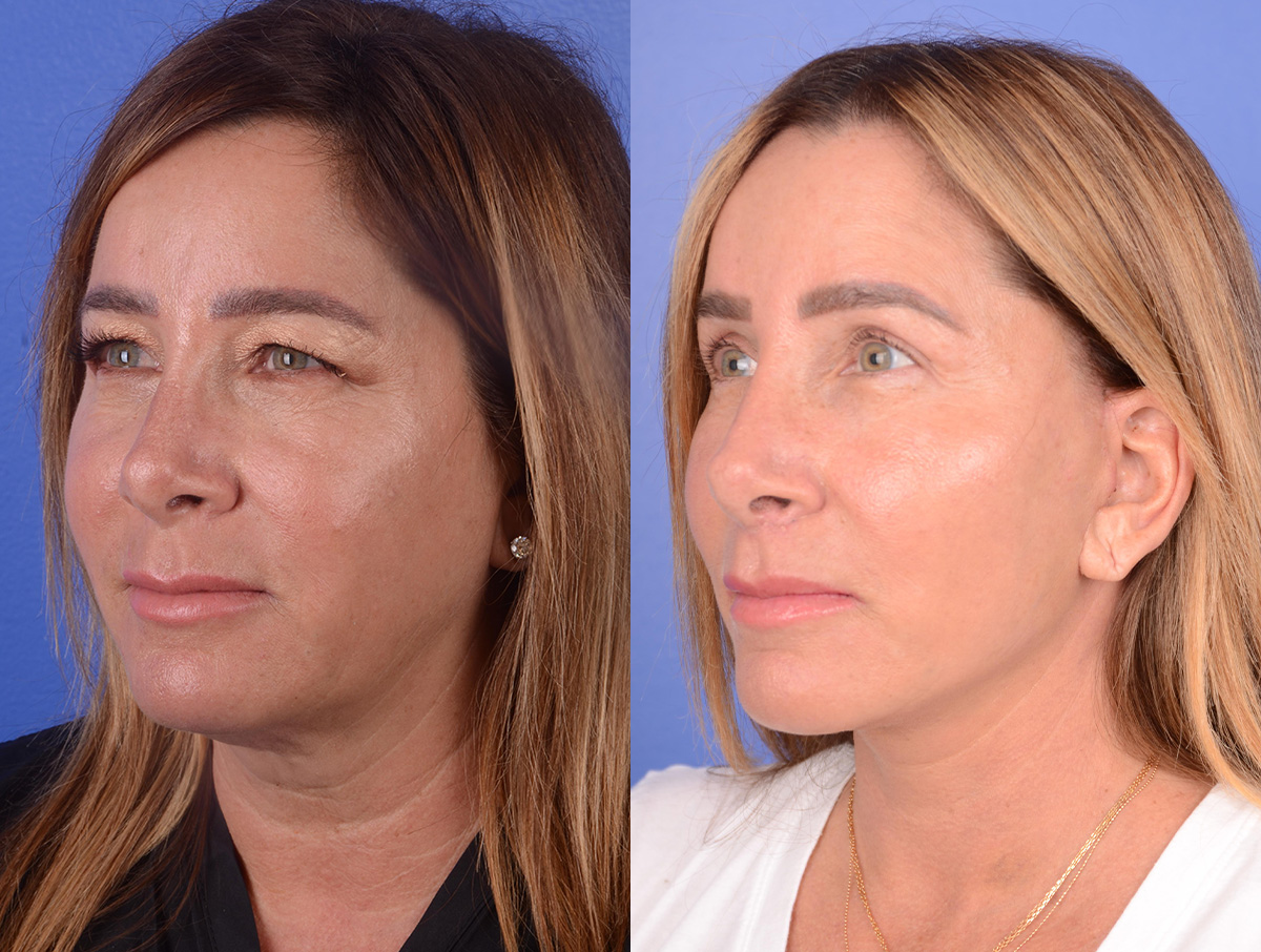 Facial Fat Grafting Before & After Gallery - Patient 351467 - Image 2