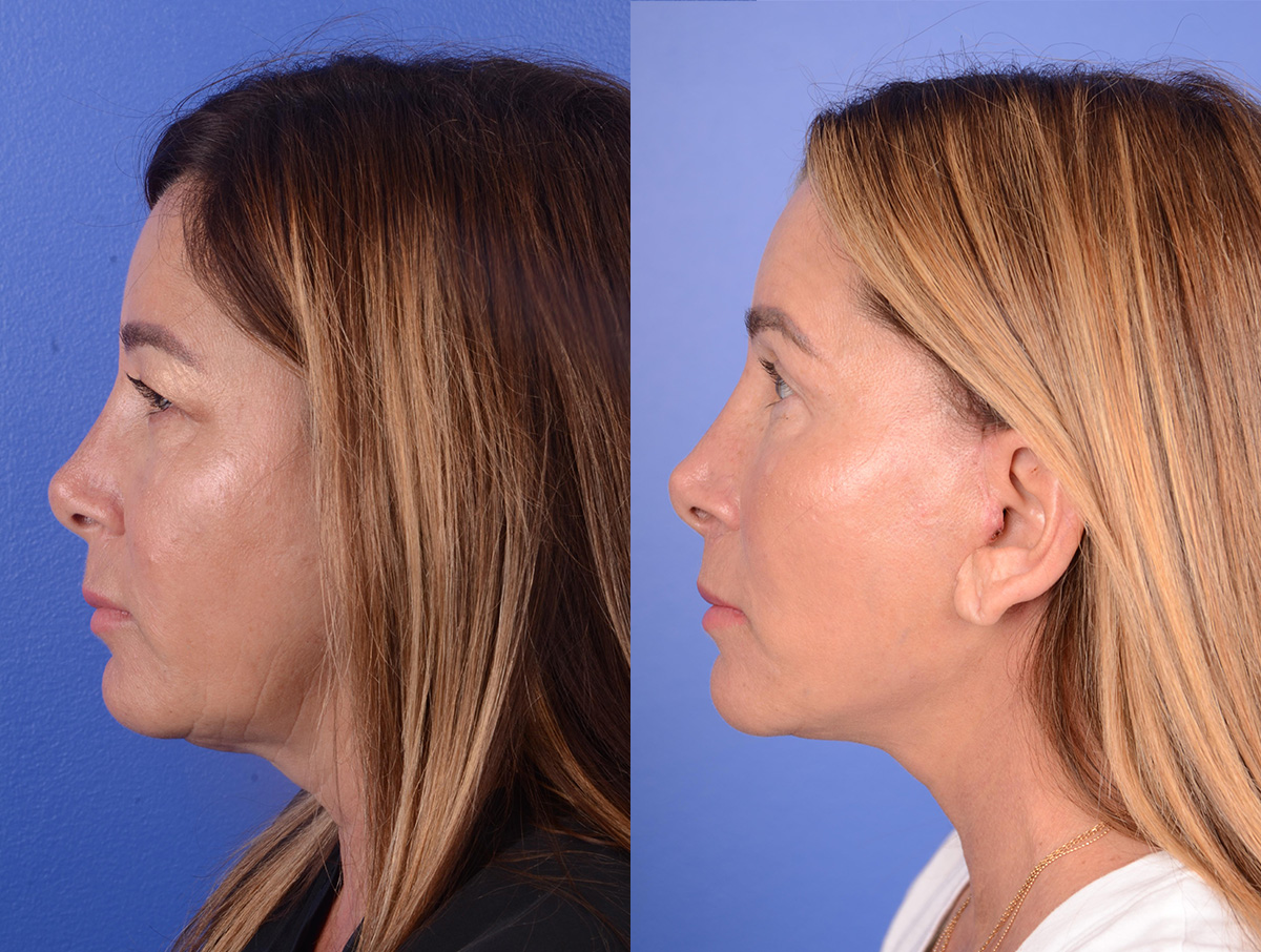 Facial Fat Grafting Before & After Gallery - Patient 351467 - Image 3