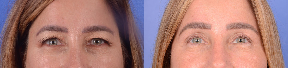 Blepharoplasty Before & After Gallery - Patient 181104 - Image 1