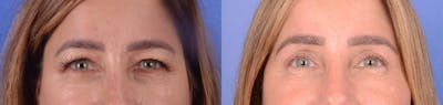 Blepharoplasty Before & After Gallery - Patient 181104 - Image 1