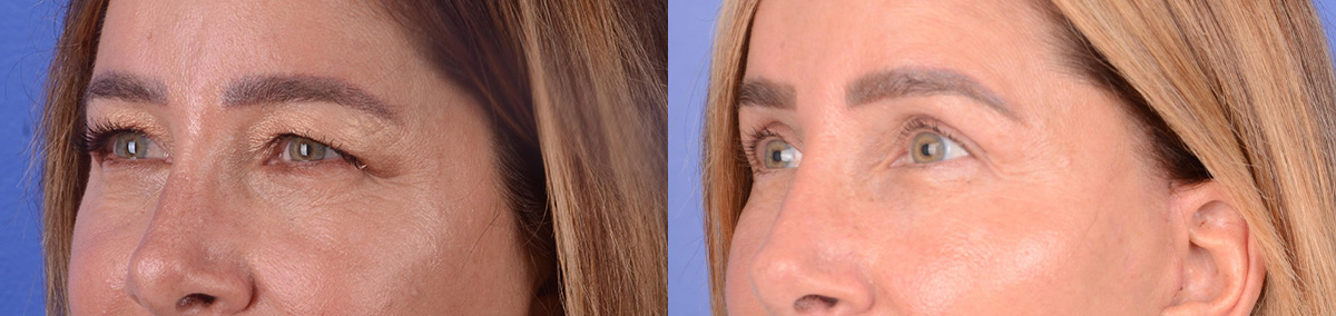 Blepharoplasty Before & After Gallery - Patient 181104 - Image 2