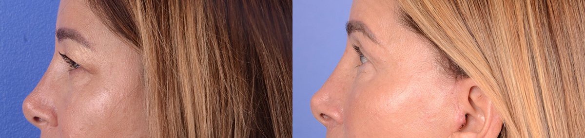 Blepharoplasty Before & After Gallery - Patient 181104 - Image 3