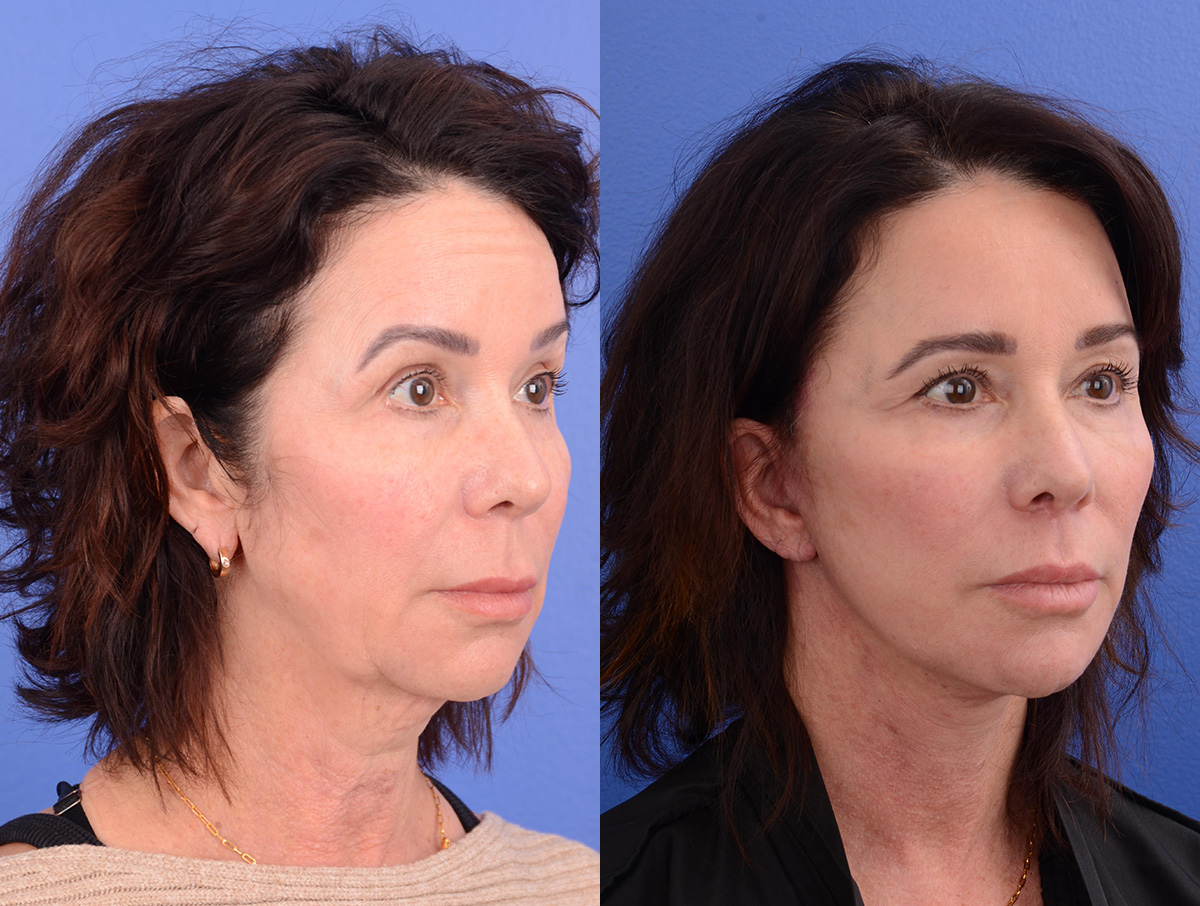 Facelift Before & After Gallery - Patient 293737 - Image 2