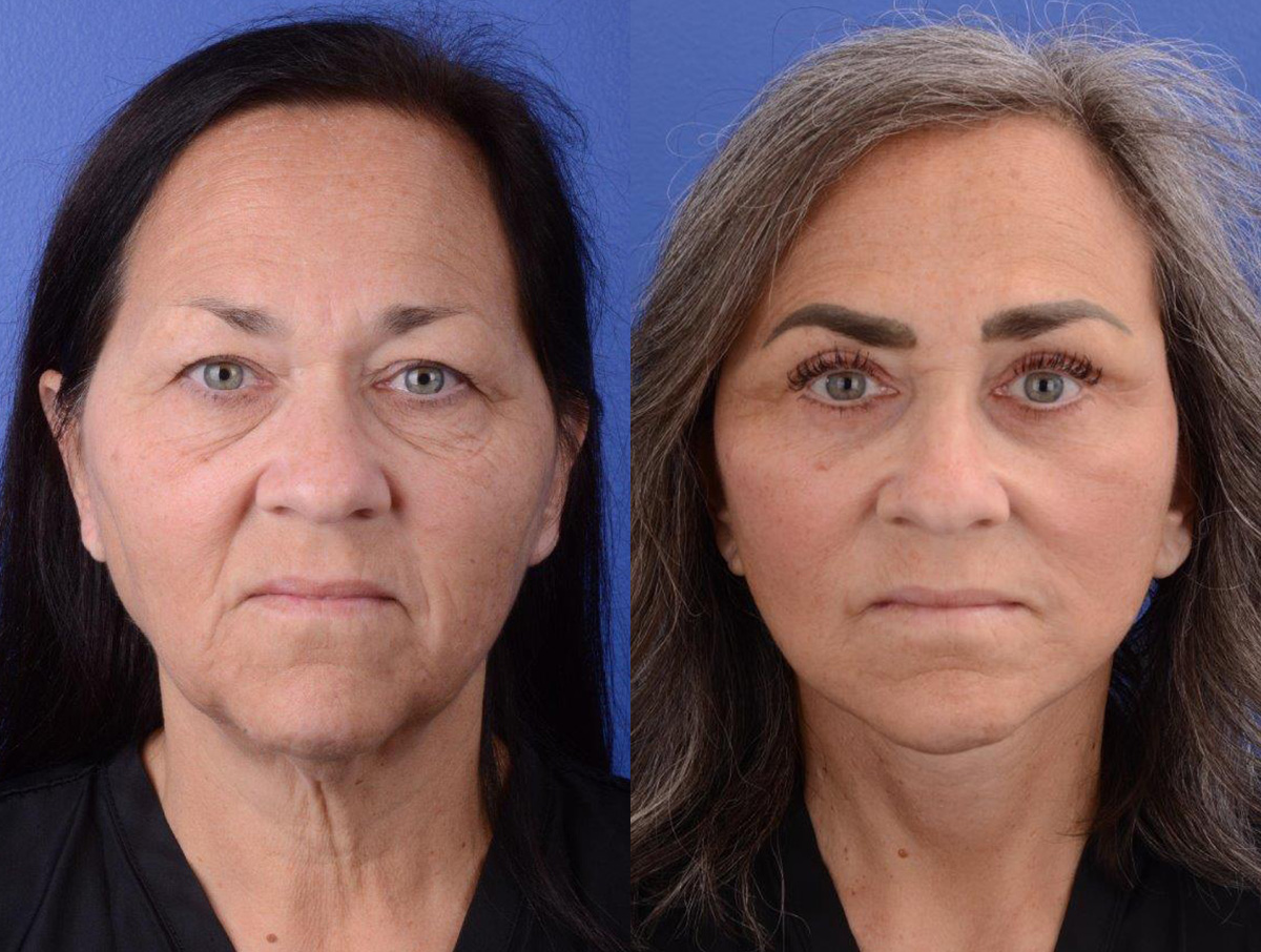 Facelift Before & After Gallery - Patient 234304 - Image 2
