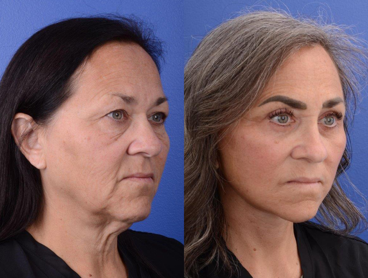 Facelift Before & After Gallery - Patient 234304 - Image 1