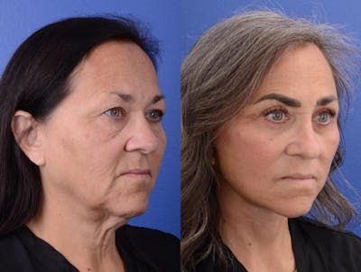Facelift Before & After Gallery - Patient 234304 - Image 1