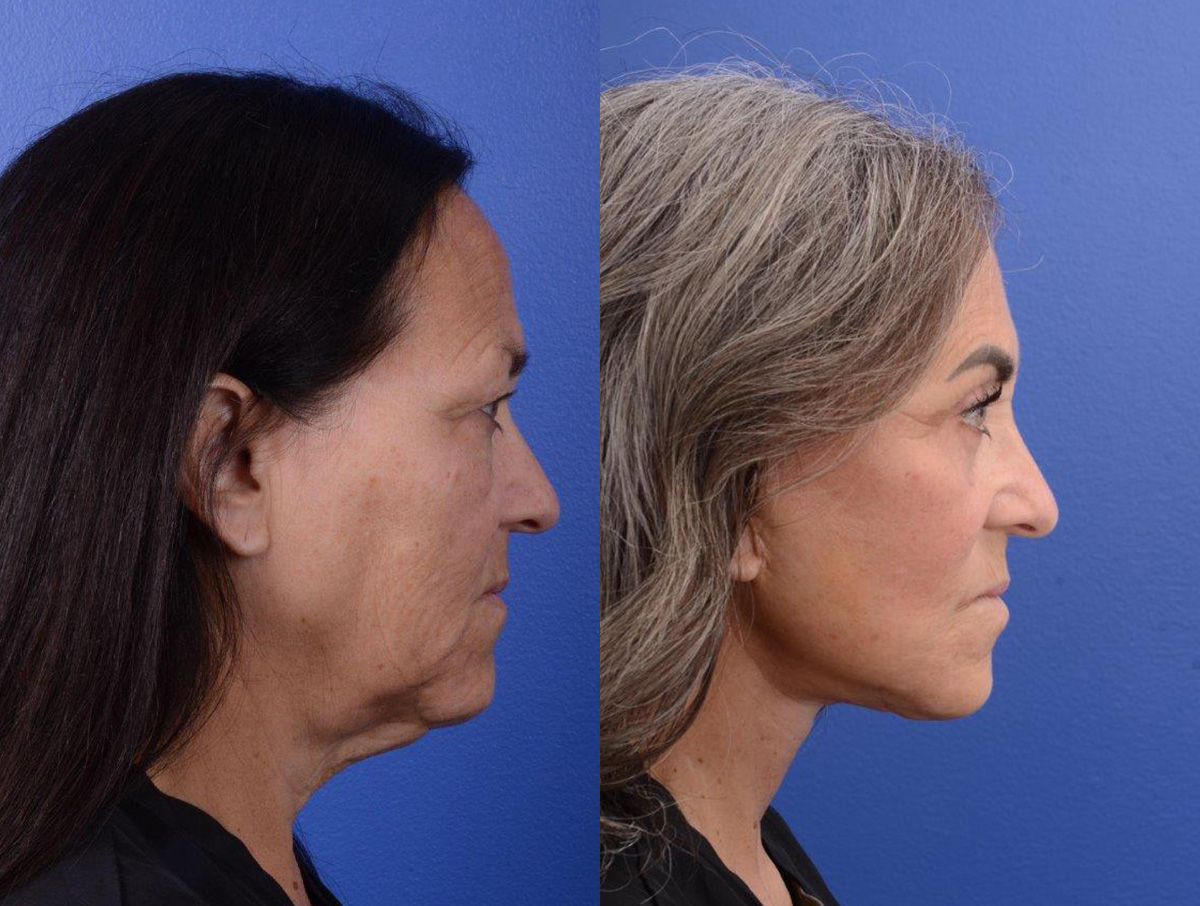 Facelift Before & After Gallery - Patient 234304 - Image 3