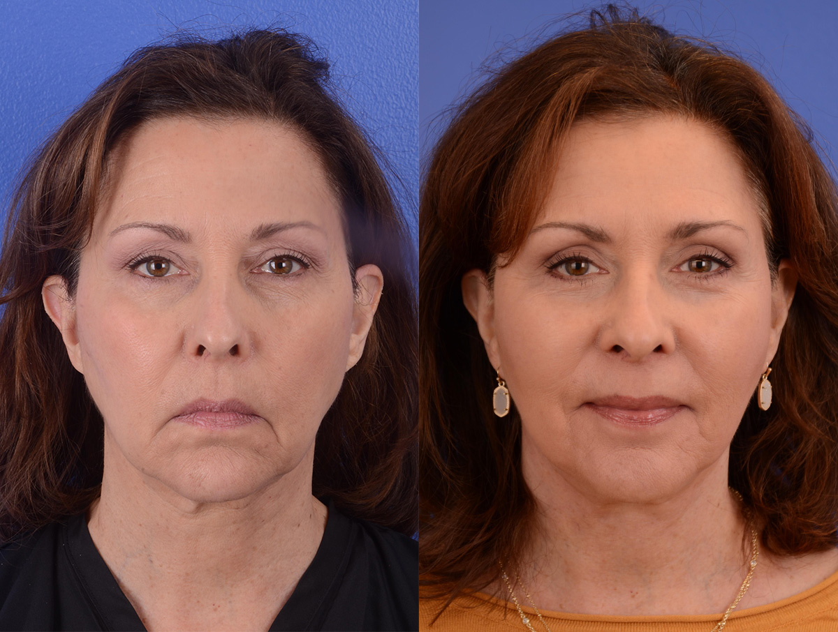Facelift Before & After Gallery - Patient 256393 - Image 1
