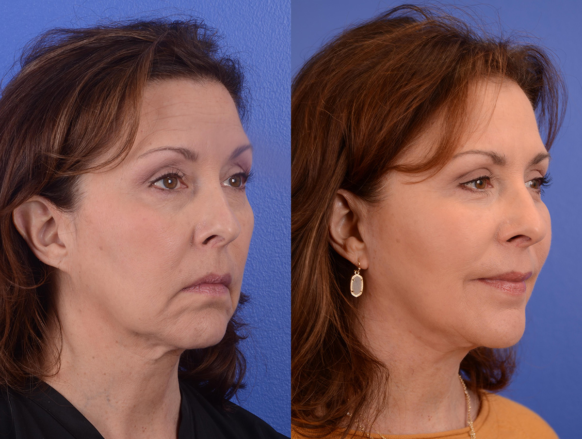 Facelift Before & After Gallery - Patient 256393 - Image 2