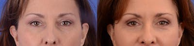 Blepharoplasty Before & After Gallery - Patient 374877 - Image 1