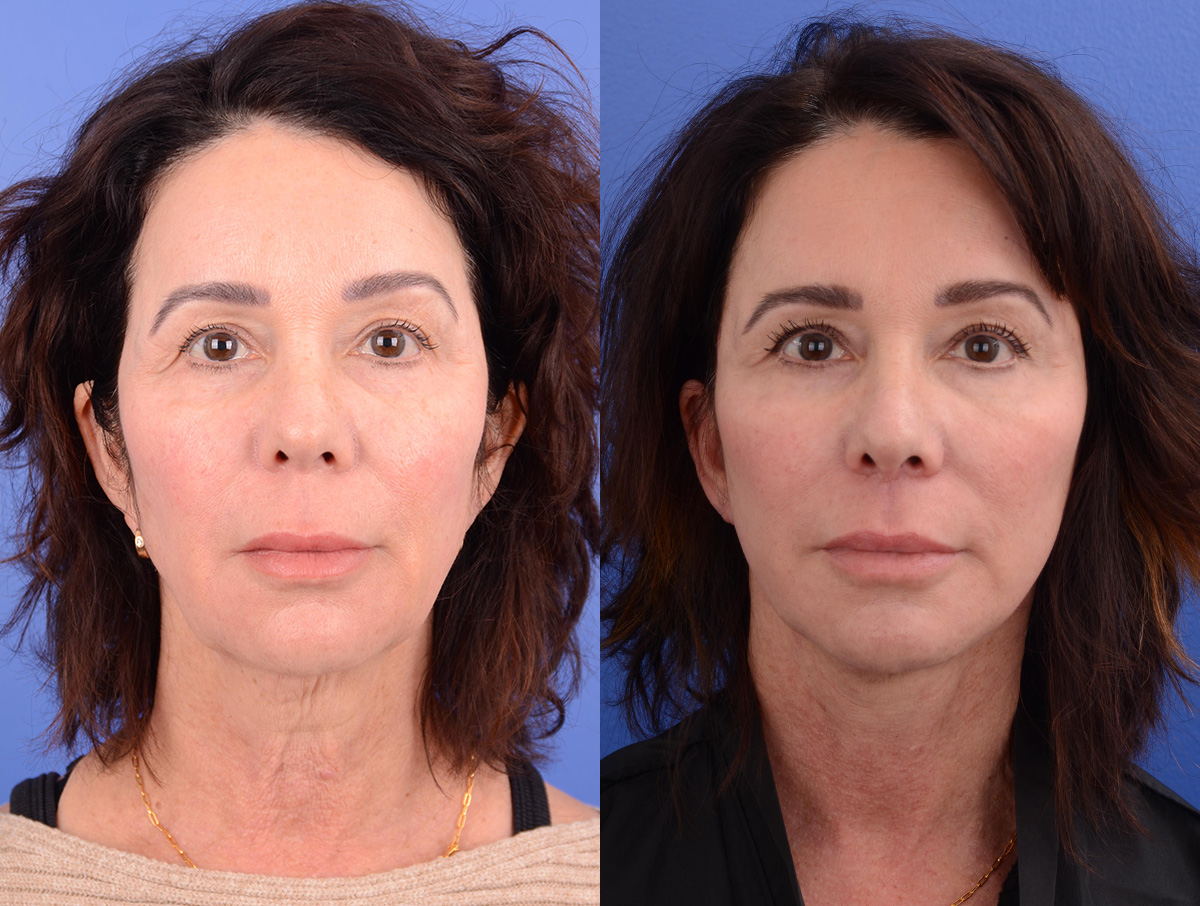 Facelift Before & After Gallery - Patient 293737 - Image 1