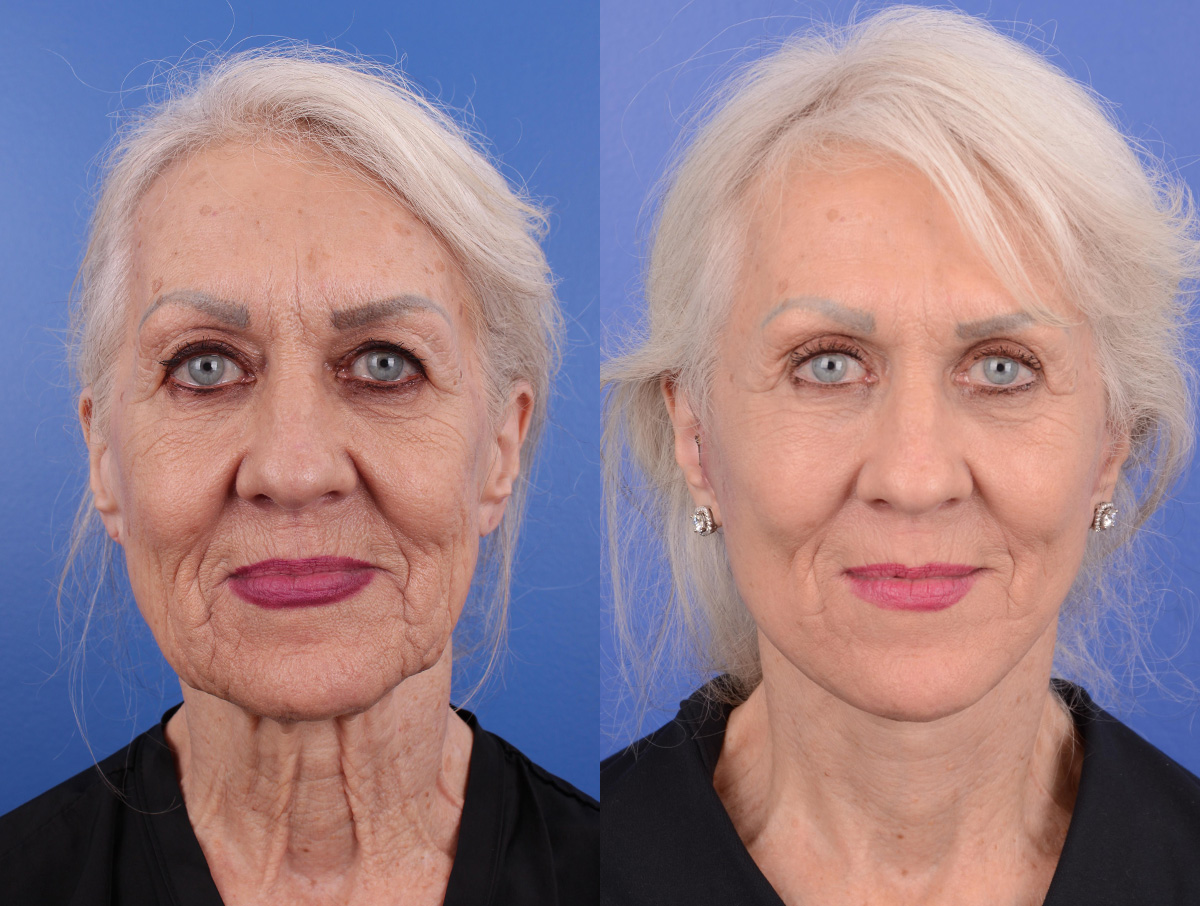 Facelift Before & After Gallery - Patient 404568 - Image 1