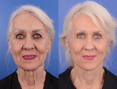 Simplicity Neck Lift Before & After Gallery - Patient 233750 - Image 1