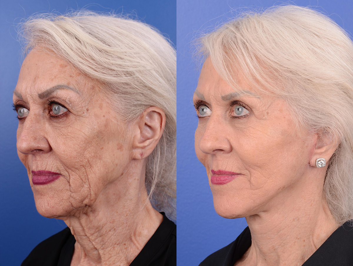 Facelift Before & After Gallery - Patient 404568 - Image 2