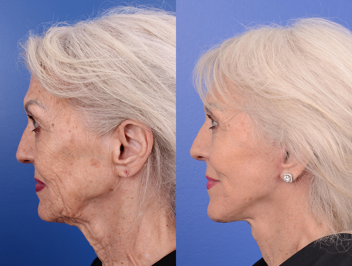 Facelift Before & After Gallery - Patient 404568 - Image 3