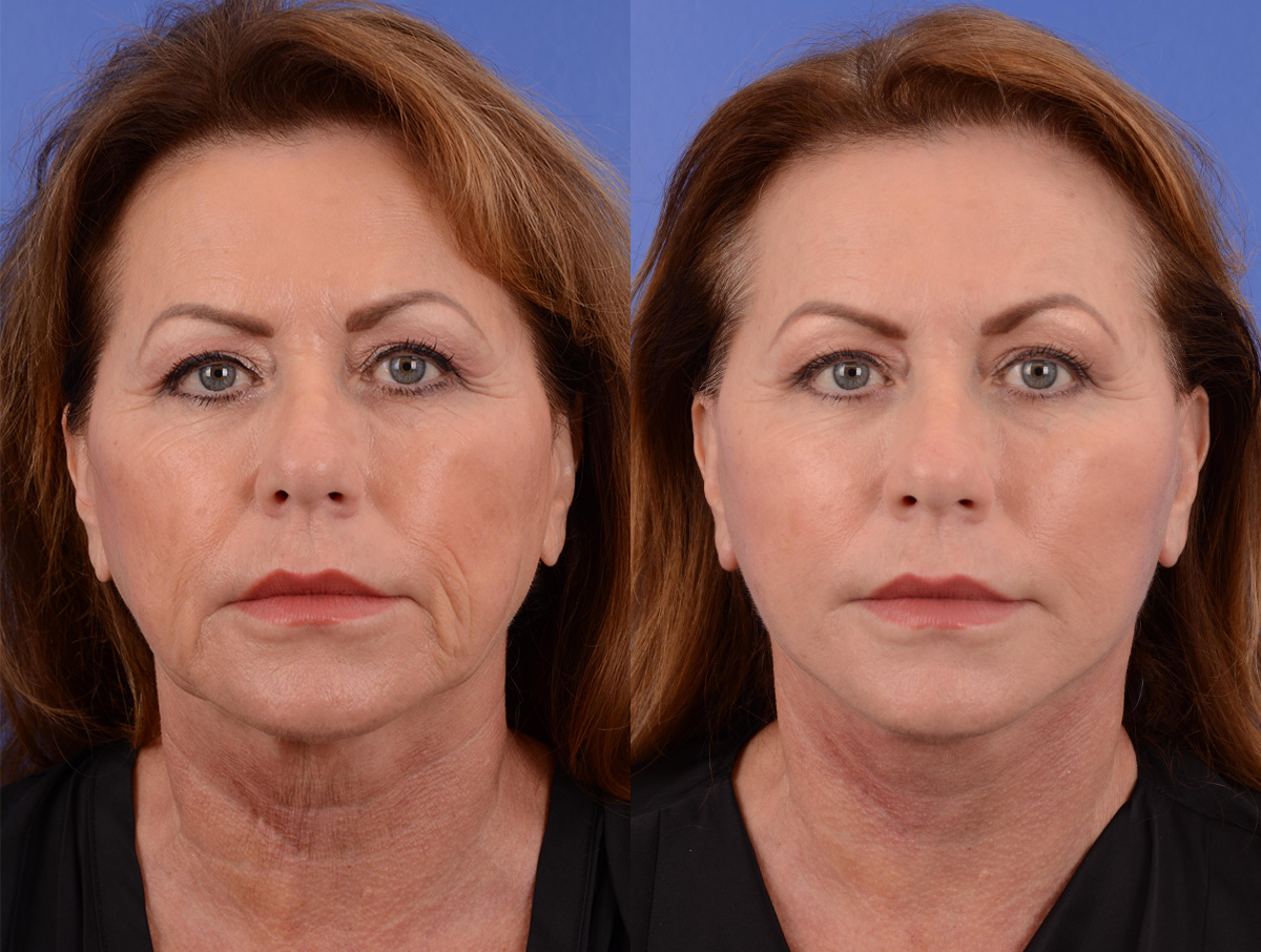 Facelift Before & After Gallery - Patient 319774 - Image 1