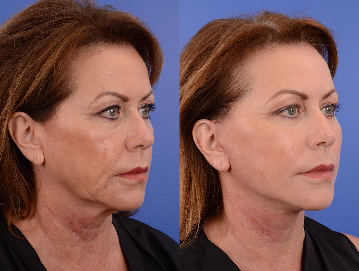 Facelift Before & After Gallery - Patient 319774 - Image 2