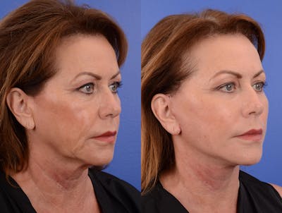 Simplicity Neck Lift Before & After Gallery - Patient 329523 - Image 1