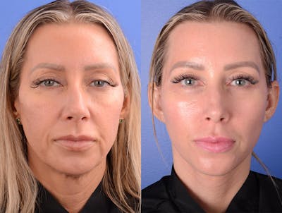 Facelift Before & After Gallery - Patient 116893 - Image 1