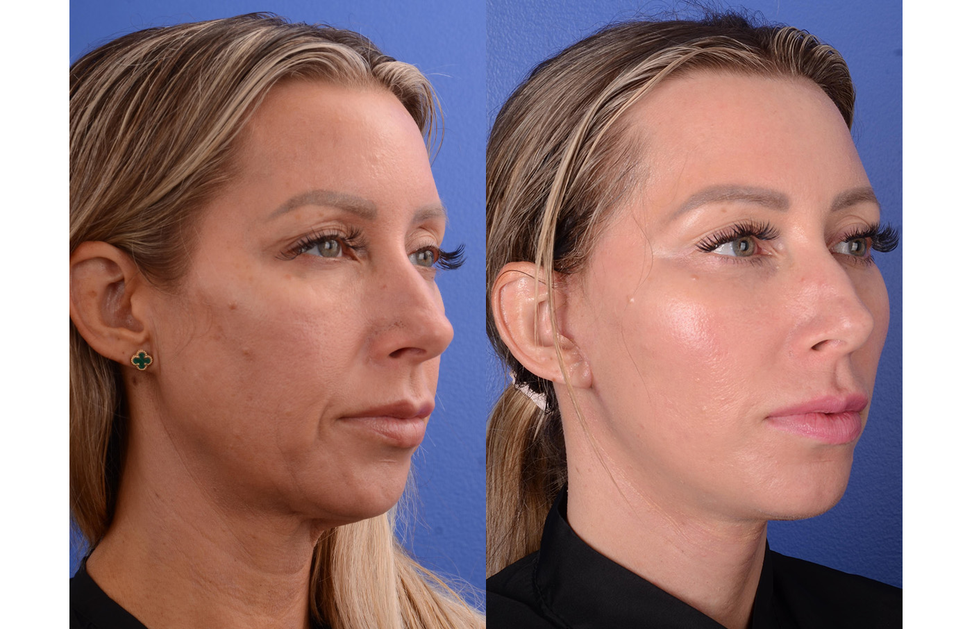 Facelift Before & After Gallery - Patient 116893 - Image 2