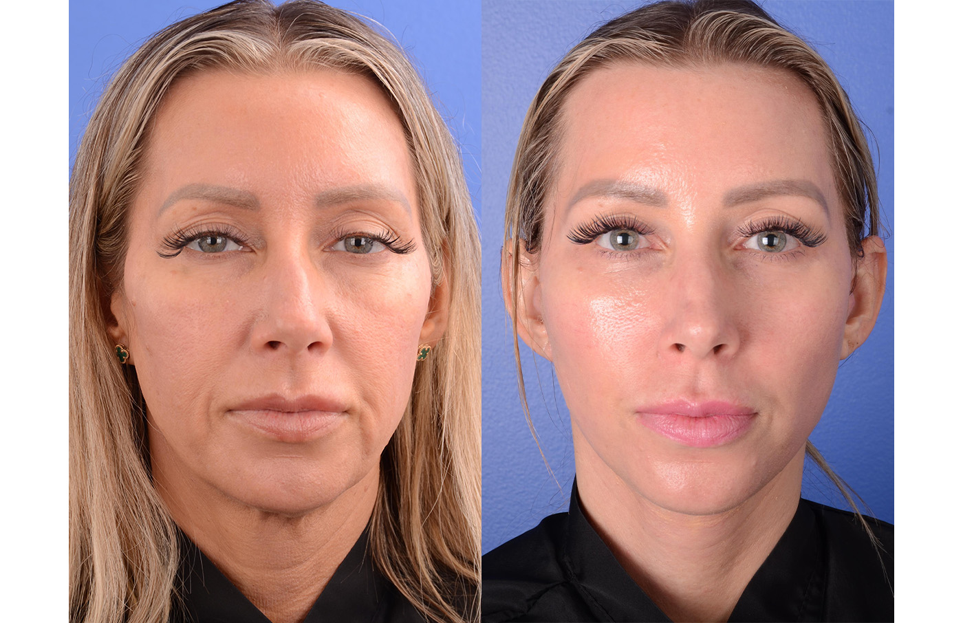Facelift Before & After Gallery - Patient 116893 - Image 1