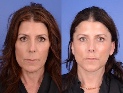 Facelift Before & After Gallery - Patient 261613 - Image 1