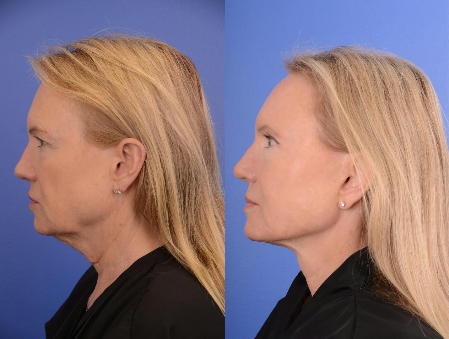 Facelift Before & After Gallery - Patient 152090 - Image 3