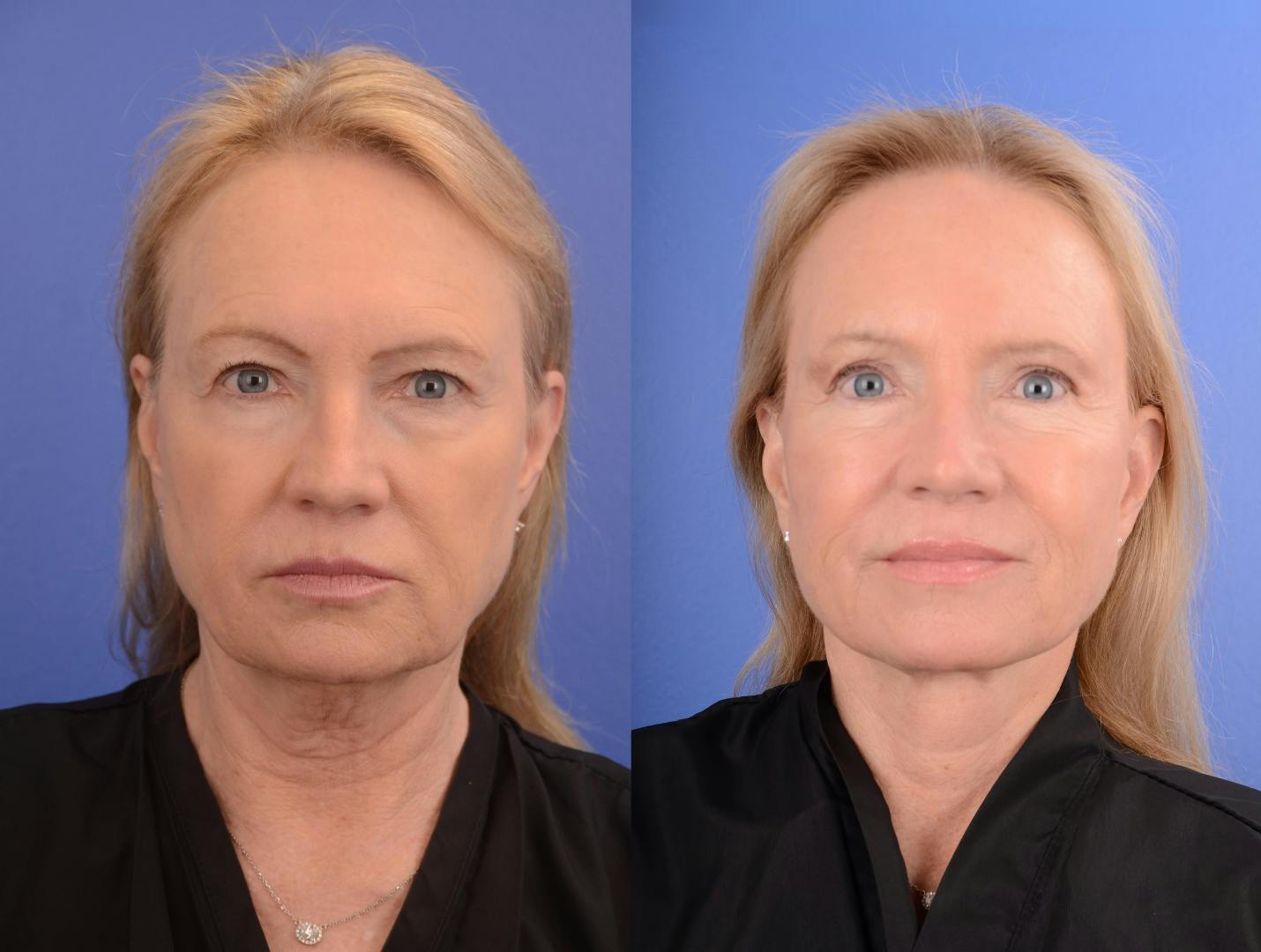 Facelift Before & After Gallery - Patient 152090 - Image 1