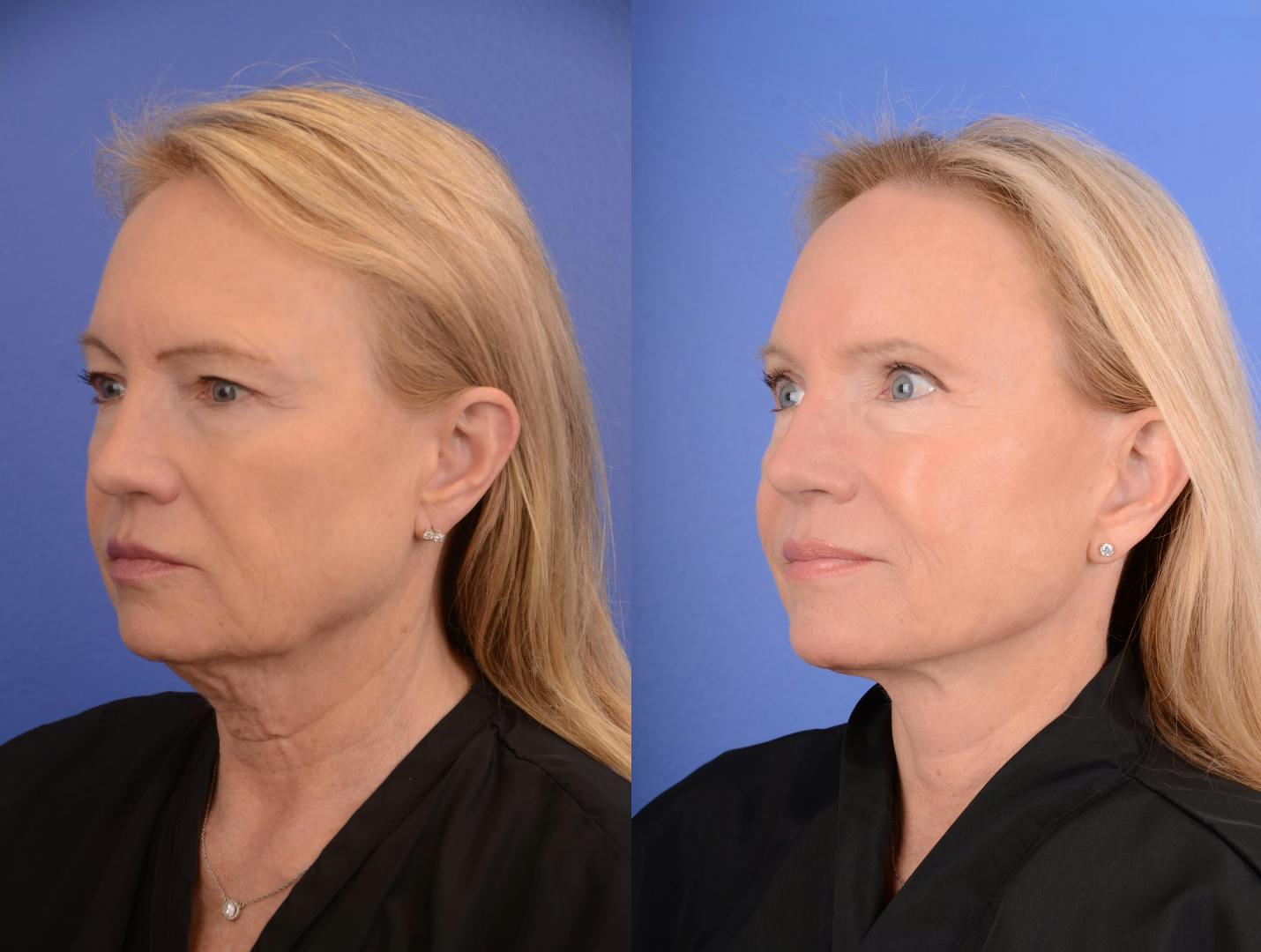 Facelift Before & After Gallery - Patient 152090 - Image 2