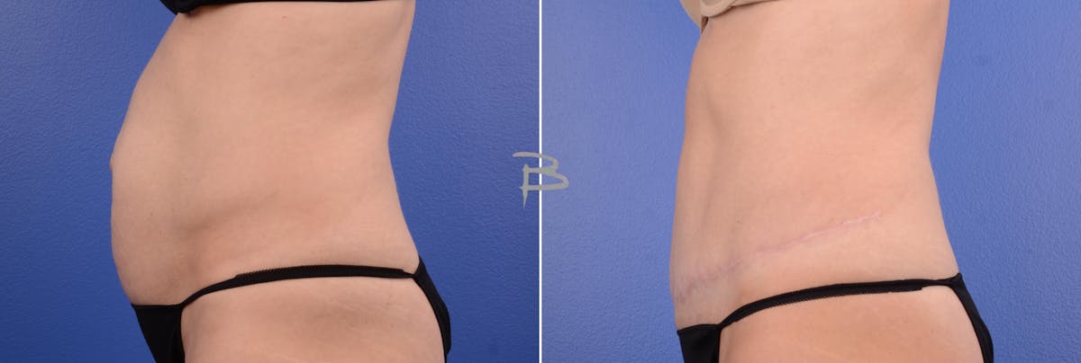 Abdominoplasty Before & After Gallery - Patient 351396 - Image 3