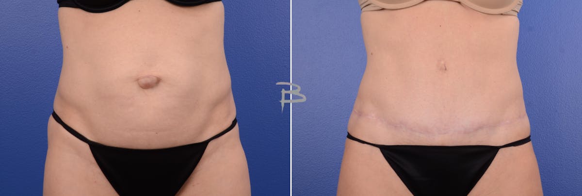 Abdominoplasty Before & After Gallery - Patient 351396 - Image 1