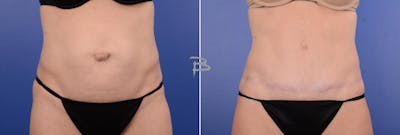 Abdominoplasty Before & After Gallery - Patient 351396 - Image 1