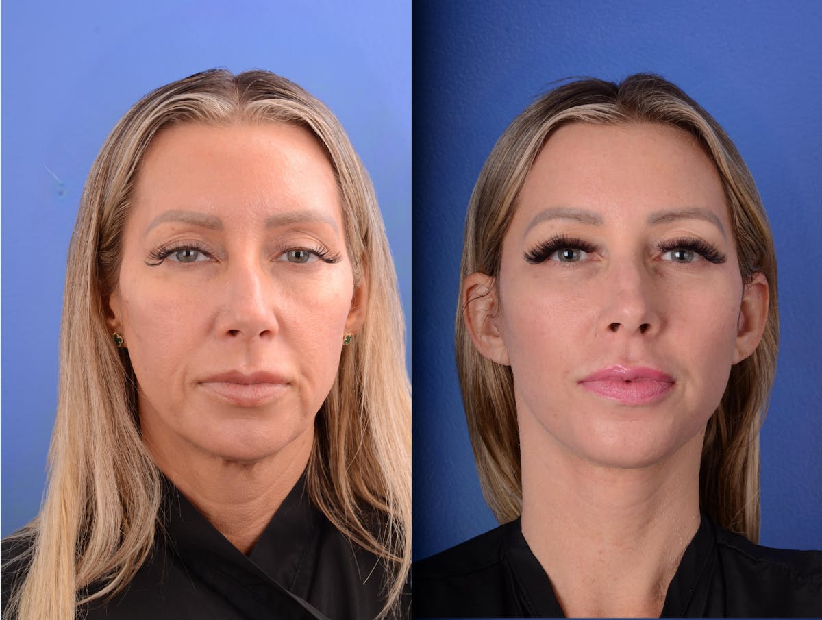 Simplicity Neck Lift Before & After Gallery - Patient 122125 - Image 1
