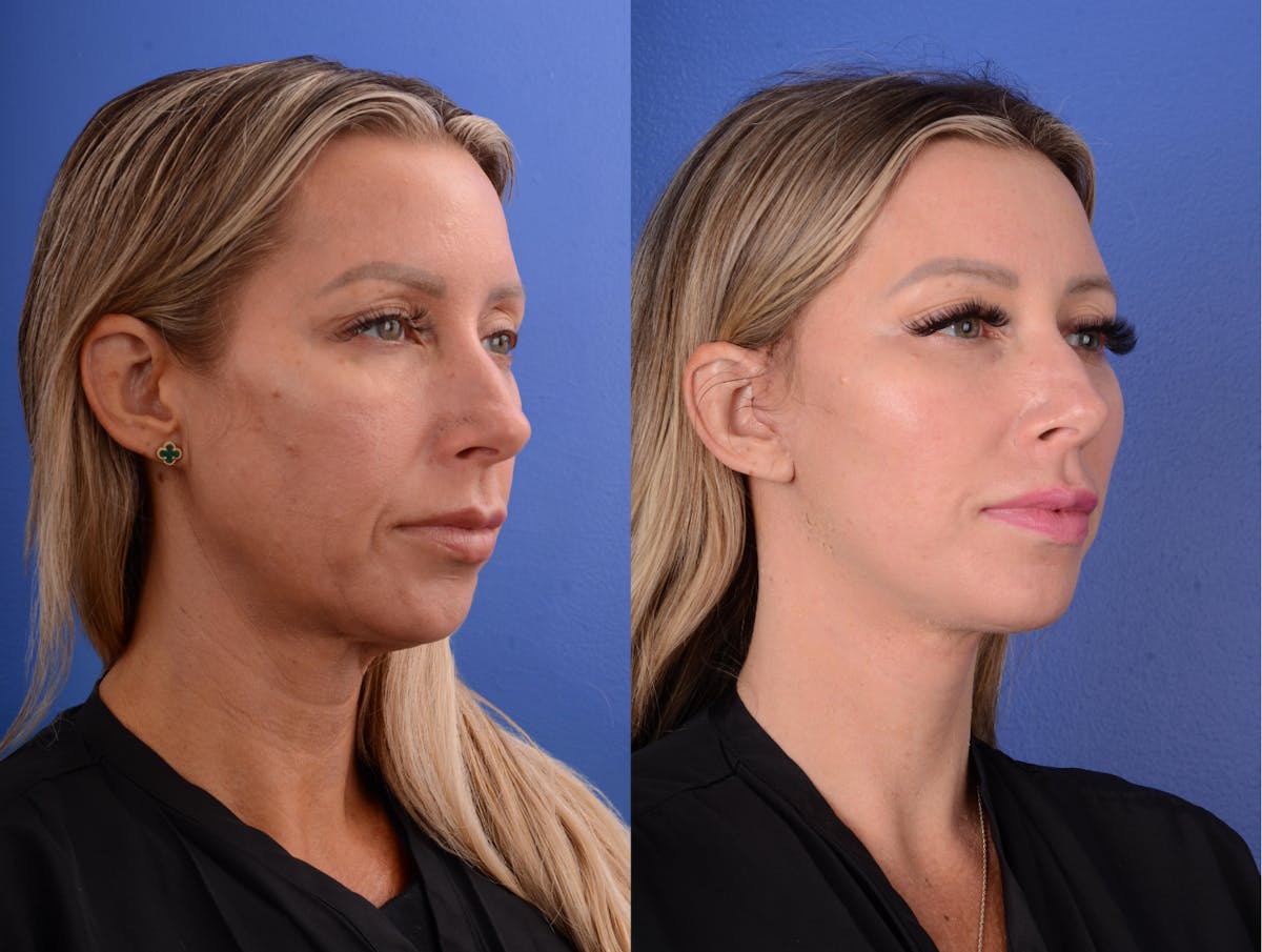 Simplicity Neck Lift Before & After Gallery - Patient 122125 - Image 2
