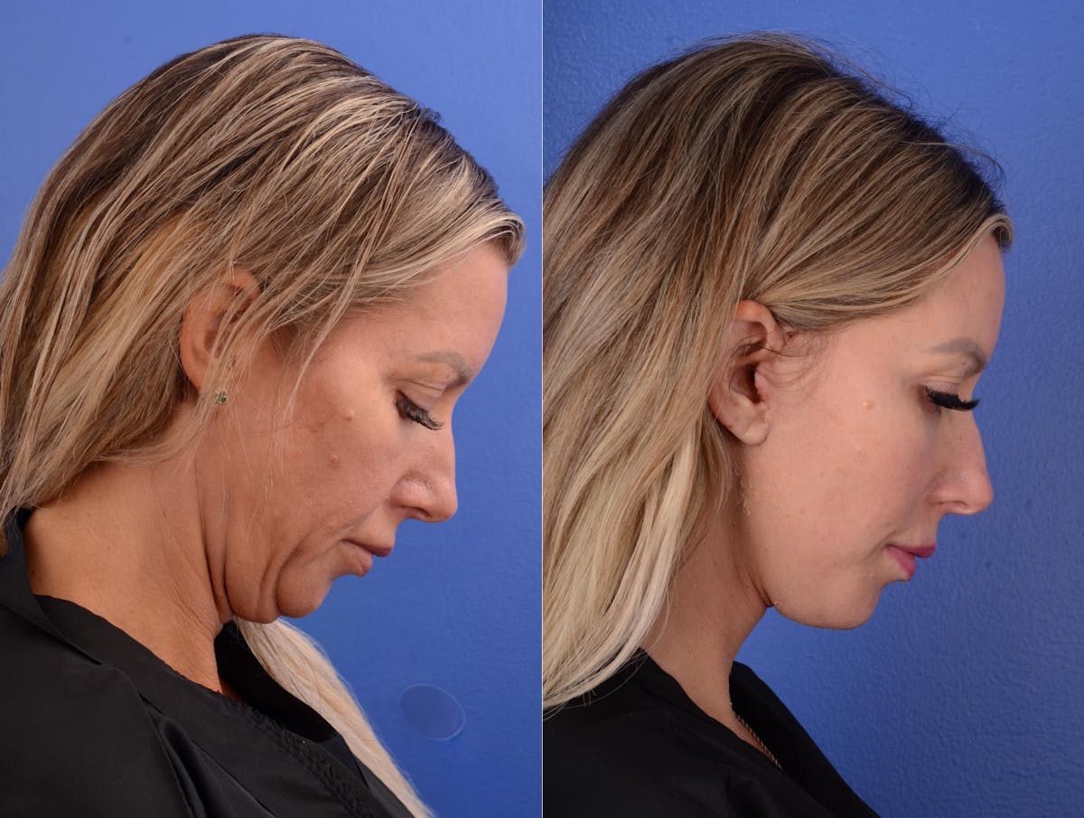 Simplicity Neck Lift Before & After Gallery - Patient 122125 - Image 3