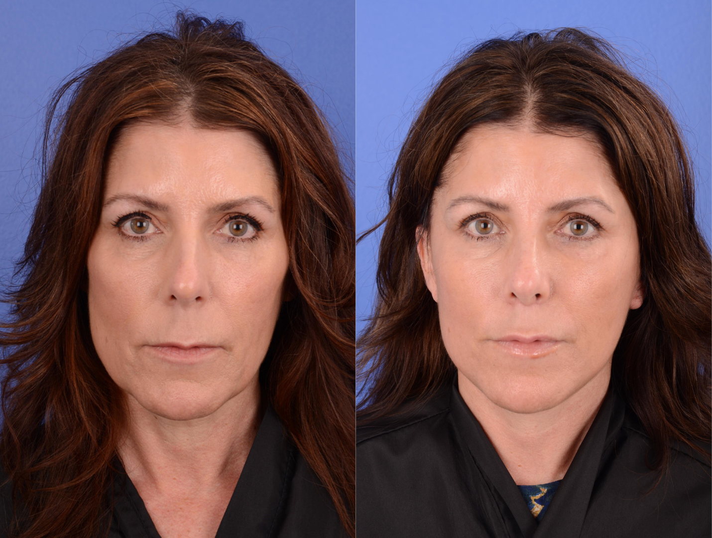 Facelift Before & After Gallery - Patient 261613 - Image 1