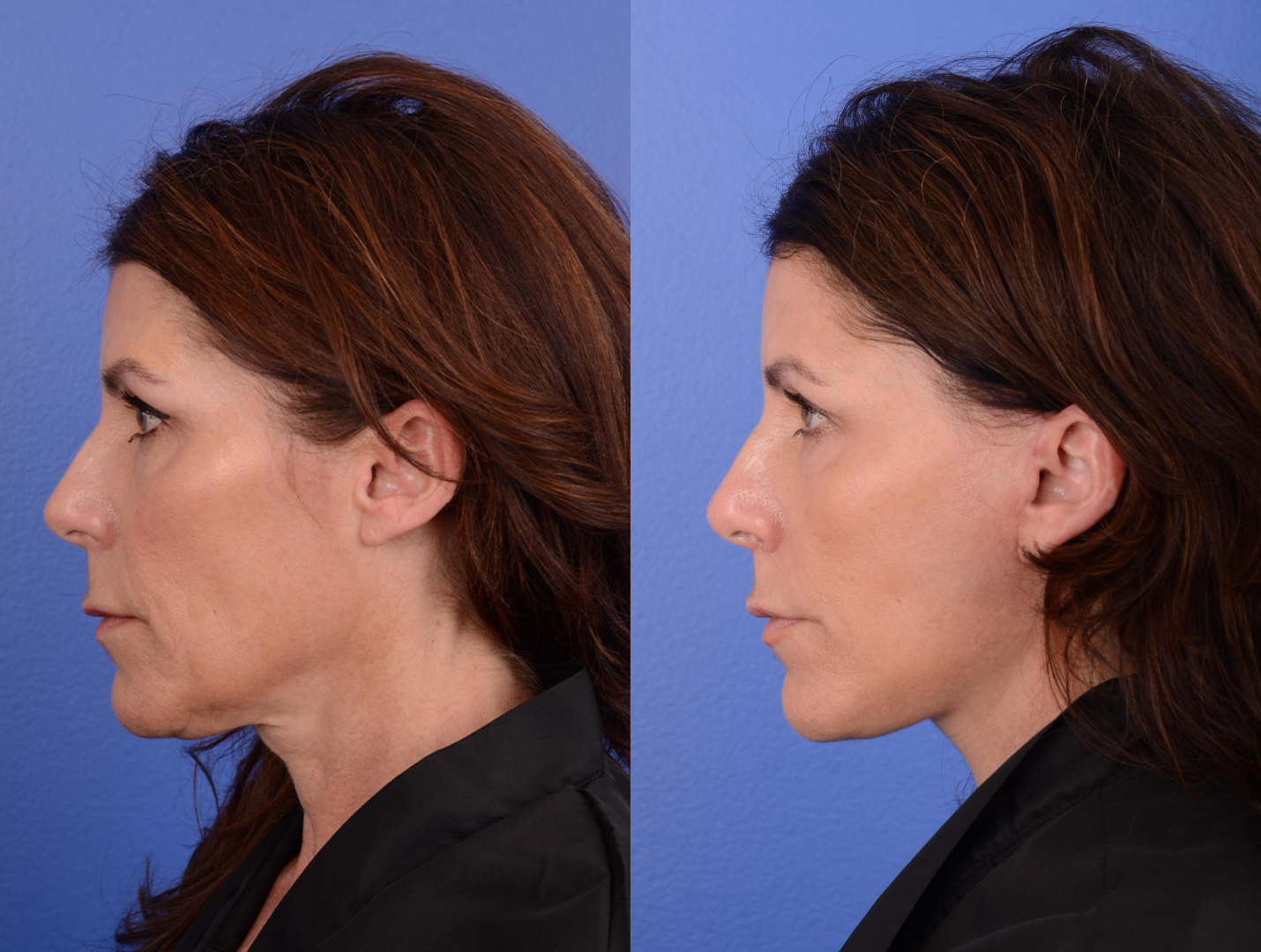 Facelift Before & After Gallery - Patient 261613 - Image 2